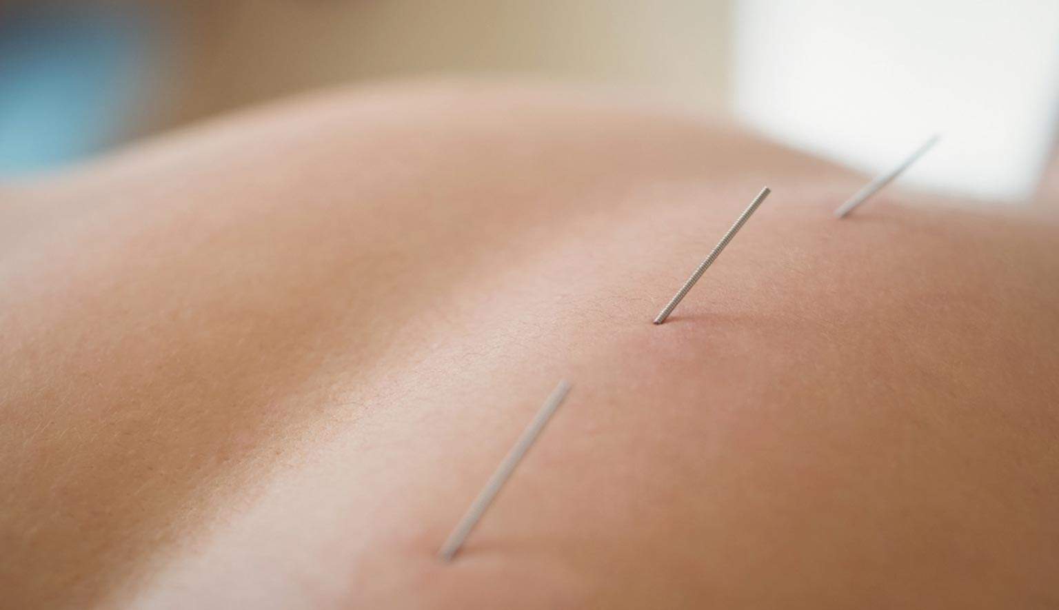 Fisioterapia profesional con punción seca en Arganzuela